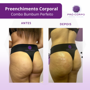 preenchimento-bumbum